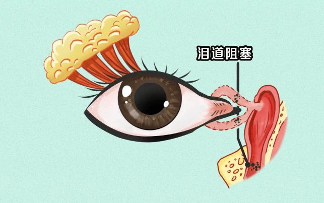 【吉林市爱尔眼科医院】侣晓梅提醒：别让眼泪白流，泪道健康科普指南